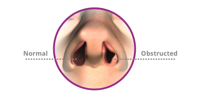 Nasal Obstruction Procedure